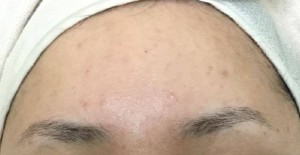 Forehead-b4